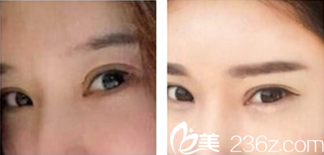 崔貴東院長做半眉案例對比圖