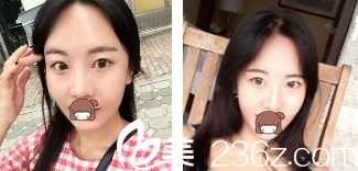 玻尿酸豐下巴加瘦臉整形案例