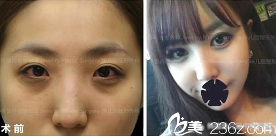 韓國珠兒麗整形眼綜合及隆鼻效果對比照