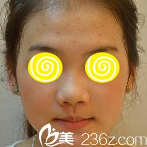 在韓國(guó)藍(lán)天感覺(jué)做注射隆鼻前 在韓國(guó)藍(lán)天感覺(jué)做注射隆鼻前