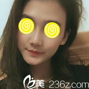 玻尿酸隆鼻術(shù)后第三天效果 玻尿酸隆鼻術(shù)后第三天效果