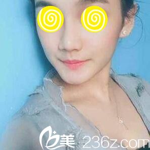 在韓國(guó)藍(lán)天感覺(jué)昨玻尿酸隆鼻第五天效果 在韓國(guó)藍(lán)天感覺(jué)昨玻尿酸隆鼻第五天效果