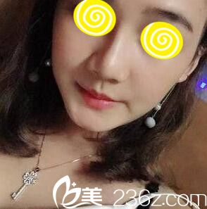 在韓國(guó)注射玻尿酸隆鼻半個(gè)月效果 在韓國(guó)注射玻尿酸隆鼻半個(gè)月效果