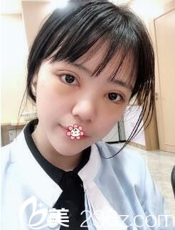 黃皓雙眼皮加開內(nèi)眼角術(shù)后五天