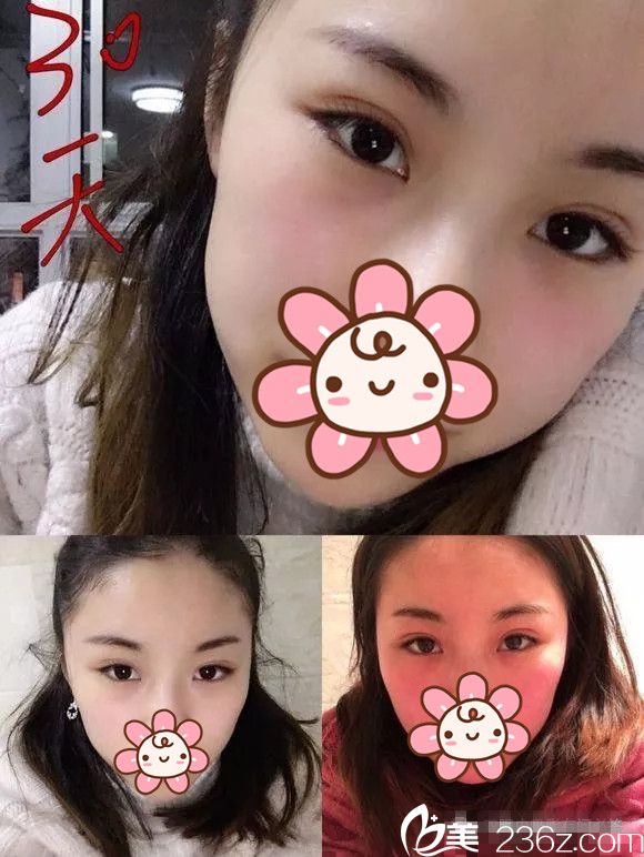 誰說內(nèi)雙不能做埋線雙眼皮?看箍牙妹在無錫同舟術后一個月恢復效果圖