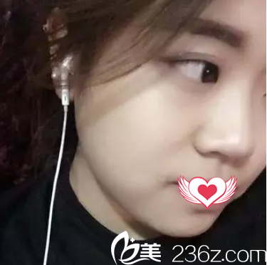 術前鼻子扁平 術前鼻子扁平