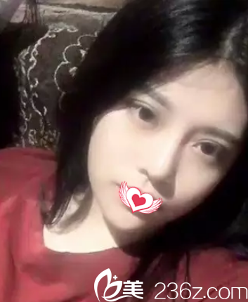 硅膠隆鼻10天后鼻子消腫 硅膠隆鼻10天后鼻子消腫