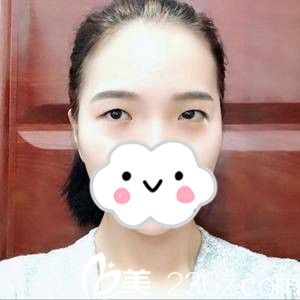 單眼皮的我 單眼皮的我