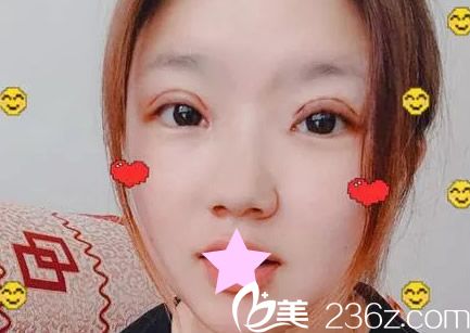 割雙眼皮第四天