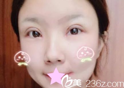 切開雙眼皮第七天拆線后圖片