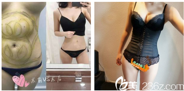 廣州美萊王志軍腰腹部抽脂案例對(duì)比圖