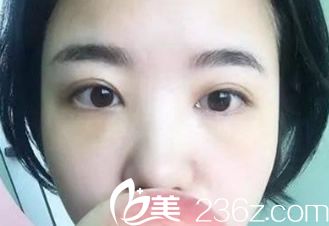 術后第7天 術后第7天