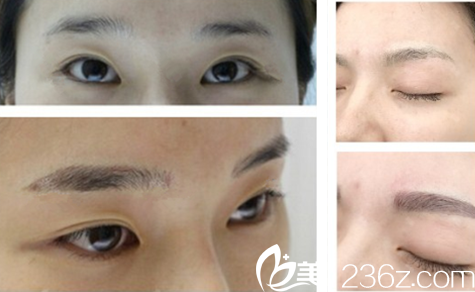 擅長半的路阿藍醫(yī)生案例對比圖