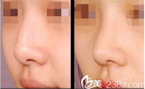 隆鼻前后對(duì)比