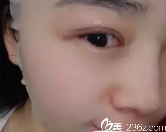 想了解廈門歐菲和美萊哪個整形好的親們 可以借鑒我在歐菲做雙眼皮和隆鼻的案例效果