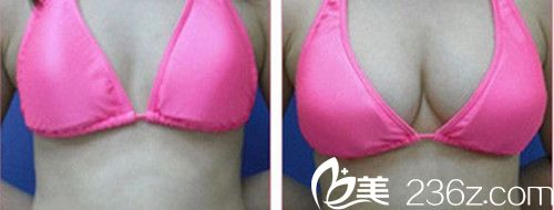 韓國(guó)美特樂整形醫(yī)院隆胸手術(shù)案例 韓國(guó)美特樂整形醫(yī)院隆胸手術(shù)案例