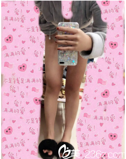 大腿吸脂術(shù)后一個(gè)月效果圖 大腿吸脂術(shù)后一個(gè)月效果圖