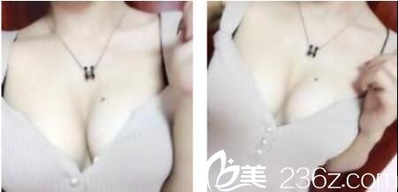 韓國樸賢整形外科樸賢自體脂肪隆胸真人案例術(shù)后一個(gè)月