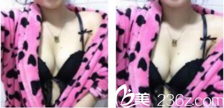 韓國樸賢整形外科樸賢自體脂肪隆胸真人案例術(shù)后三個(gè)月