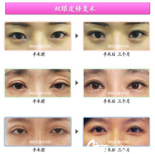 洪政槿院長(zhǎng)雙眼皮修復(fù)手術(shù)案例 洪政槿院長(zhǎng)雙眼皮修復(fù)手術(shù)案例