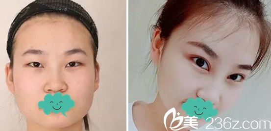 藝雅特整形醫(yī)院雙眼皮+內(nèi)開眼角案例效果對比圖 藝雅特整形醫(yī)院雙眼皮+內(nèi)開眼角案例效果對比圖