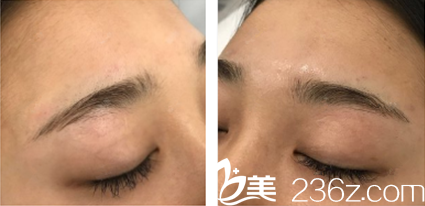 半紋眉術(shù)前眉毛稀疏 半紋眉術(shù)前眉毛稀疏