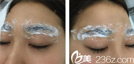 術(shù)后微腫敷著消炎藥膏 術(shù)后微腫敷著消炎藥膏