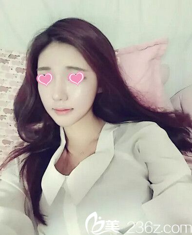 藝校妹子在韓國(guó)美特樂整形做了下頜角整形、下巴整形、顴骨縮小和面部脂肪填充