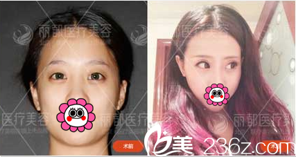 北京米蘭柏羽麗都曹衛(wèi)華韓式雙眼皮案例 北京米蘭柏羽麗都曹衛(wèi)華韓式雙眼皮案例