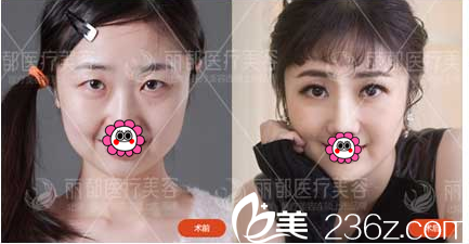 北京米蘭柏羽麗都于曉春韓式雙眼皮案例 北京米蘭柏羽麗都于曉春韓式雙眼皮案例