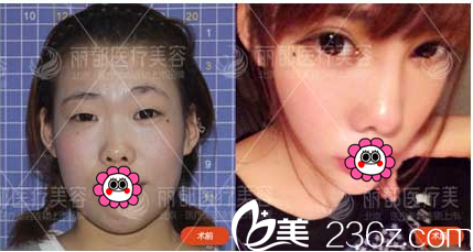 北京米蘭柏羽麗都于曉春切開雙眼皮開眼角案例 北京米蘭柏羽麗都于曉春切開雙眼皮開眼角案例