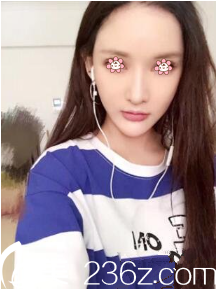 <!--<i data=20240703-sp></i>-->臉部埋線提升術(shù)后一個(gè)月