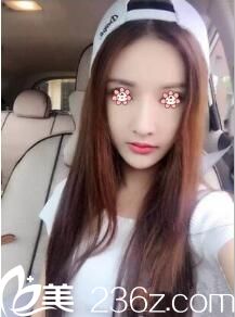 因為相信韓國整容技術(shù)我去找了韓國NU整形做全面部PPDO埋線提升。