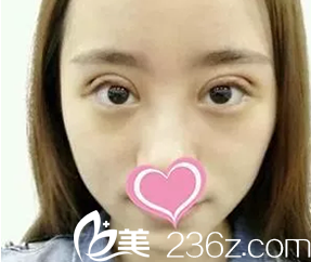 我在大同美神做韓式三點雙眼皮術(shù)后第3天照片