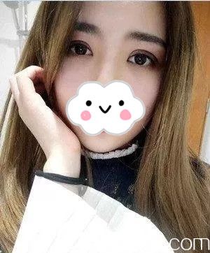 雙眼皮手術(shù)后12天 雙眼皮手術(shù)后12天