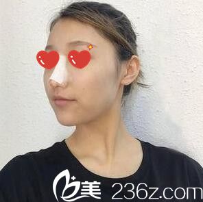 綜合立體隆鼻術(shù)后天照