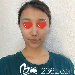 在M整形醫(yī)院做鼻綜合術(shù)后一周