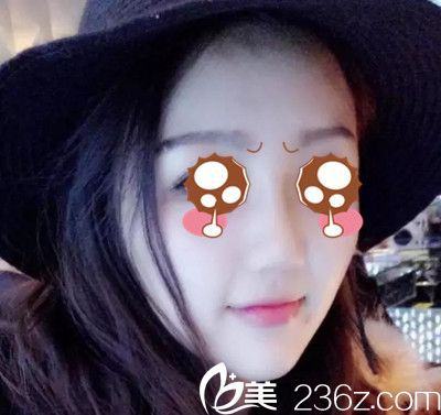 韓國摩茲整形鼻綜合案例