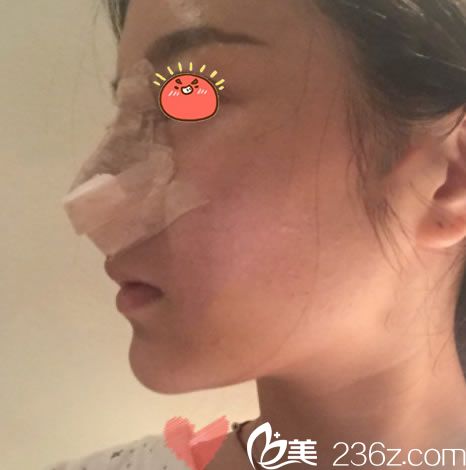 剛做完鼻綜合隆鼻手術(shù)圖片