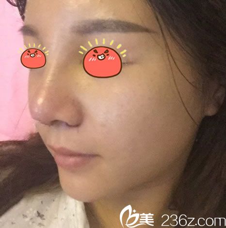 找金華亞美鄧澤臣隆鼻5天拆線圖