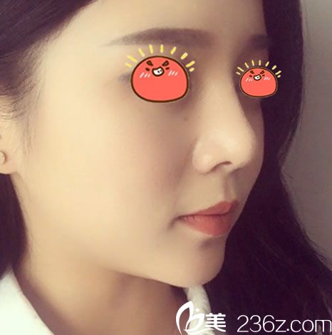 金華亞美做鼻綜合30天恢復(fù)照