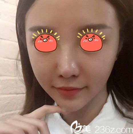 做完膨體隆鼻手術(shù)15天恢復(fù)照