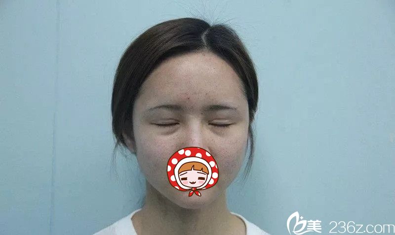 雙眼皮失敗術(shù)后一年有肉條感 雙眼皮失敗術(shù)后一年有肉條感