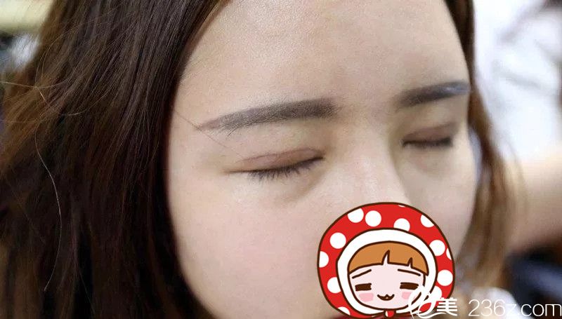 肉條感雙眼皮修復(fù)一周后恢復(fù) 肉條感雙眼皮修復(fù)一周后恢復(fù)