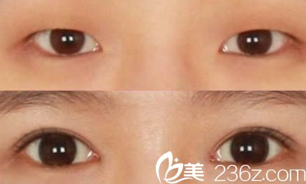 杭州維多利亞假體雙眼皮案例圖