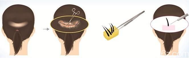 韓國延世毛百麗植發(fā)毛發(fā)移植技術(shù)特點 韓國延世毛百麗植發(fā)毛發(fā)移植技術(shù)特點