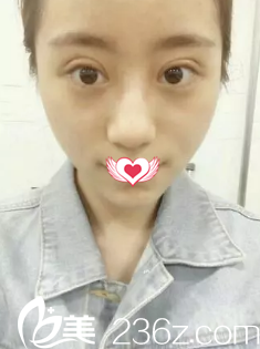 剛做完雙眼皮手術(shù)眼睛腫脹