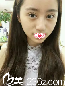 術(shù)后7天雙眼皮拆線后的樣子