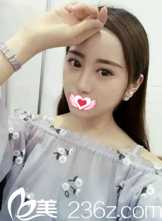 恢復(fù)20天的雙眼皮完全消腫