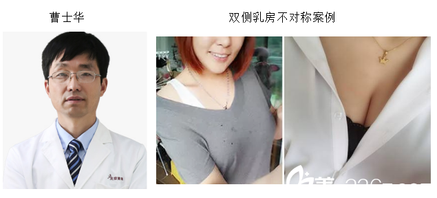 北京美萊曹士華及雙側(cè)乳房不對(duì)稱 北京美萊曹士華及雙側(cè)乳房不對(duì)稱